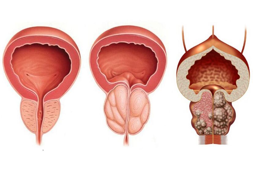 Stadien der Prostatitis und der Notwendigkeit, Prostavit voll zu verwenden